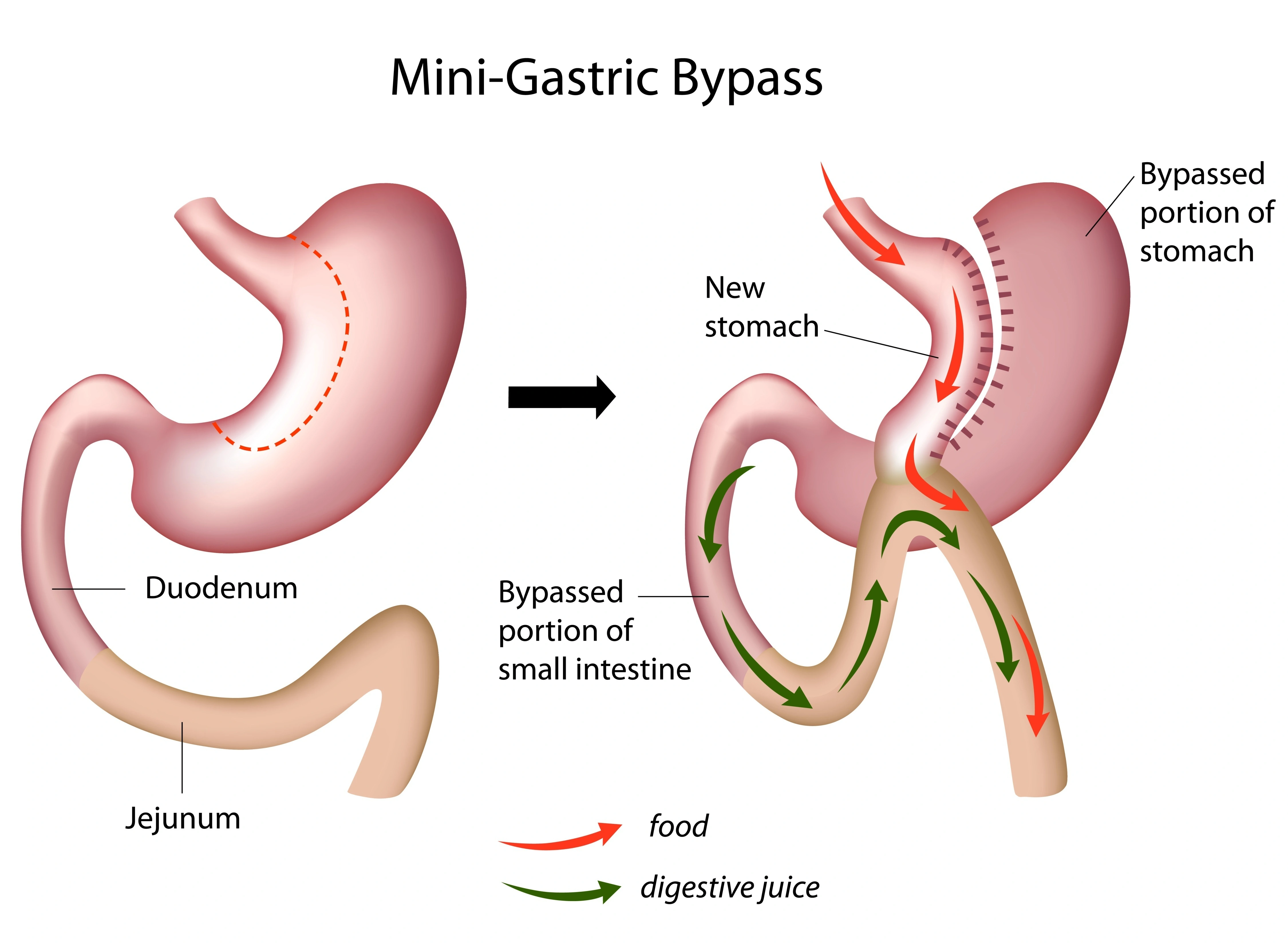 Gastric-Bypass-Surgery